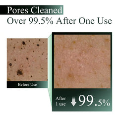 Microscopic before and after results of WhiteWay Beauty Facewash showing 99.5 percent deep pore cleansing, effectively removing blackheads, trapped dirt, and excess oil after just one use for a smoother skin texture